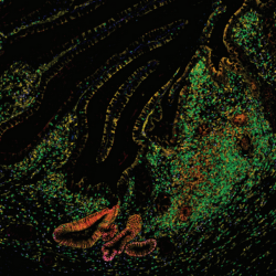 IBD gut tissue