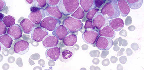 acute myeloid leukaemia cells