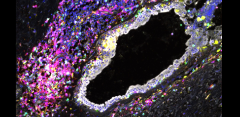 Immune cell exhaustion observed in breast tissue from carriers of BRCA1 and BRCA2 mutations long before breast cancer develops. Credit: Sara Pensa