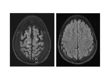 New study pinpoints cell types affected in brains of multiple sclerosis patients