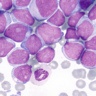 acute myeloid leukaemia cells