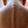 New charity - Myelopathy.org - launched