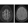 New study pinpoints cell types affected in brains of multiple sclerosis patients