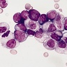 Roots of Leukaemia reveal possibility of predicting people at risk