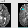 Stem cell studies offer hope for childhood neurological condition