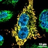 Deficient methylation and formylation of mt-tRNAMet wobble cytosine in a patient lacking NSUN3