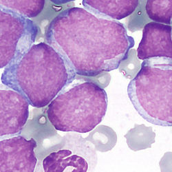 acute myeloid leukaemia cells