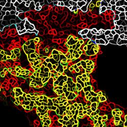  Cancer cells ‘corrupt’ their healthy neighbours