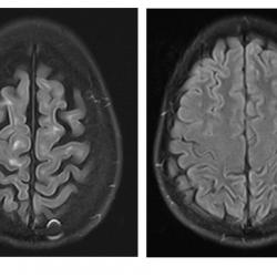 New study pinpoints cell types affected in brains of multiple sclerosis patients