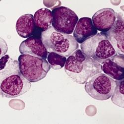 Roots of Leukaemia reveal possibility of predicting people at risk