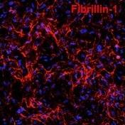 New research from Sinha Lab recreates genetic heart disease in a dish