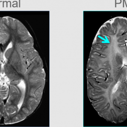 Stem cell studies offer hope for childhood neurological condition