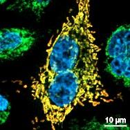 Deficient methylation and formylation of mt-tRNAMet wobble cytosine in a patient lacking NSUN3