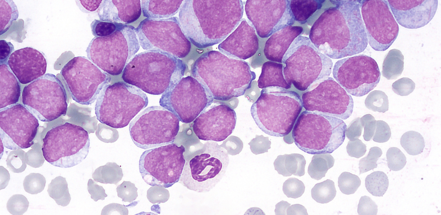 acute myeloid leukaemia cells acute myeloid leukaemia cells