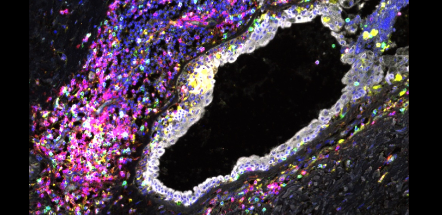 Immune cell exhaustion observed in breast tissue from carriers of BRCA1 and BRCA2 mutations long before breast cancer develops. Credit: Sara Pensa Immune cell exhaustion observed in breast tissue from carriers of BRCA1 and BRCA2 mutations long before breast cancer develops. Credit: Sara Pensa