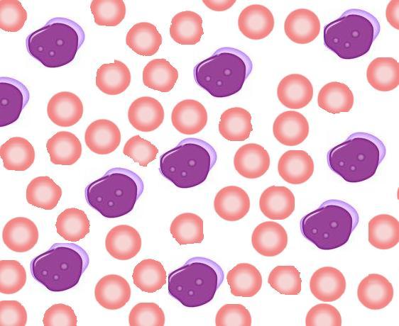 Schematic showing the appearance of acute myeloblastic leukemia, M0 under microscope New drug target discovered for acute myeloid leukaemia