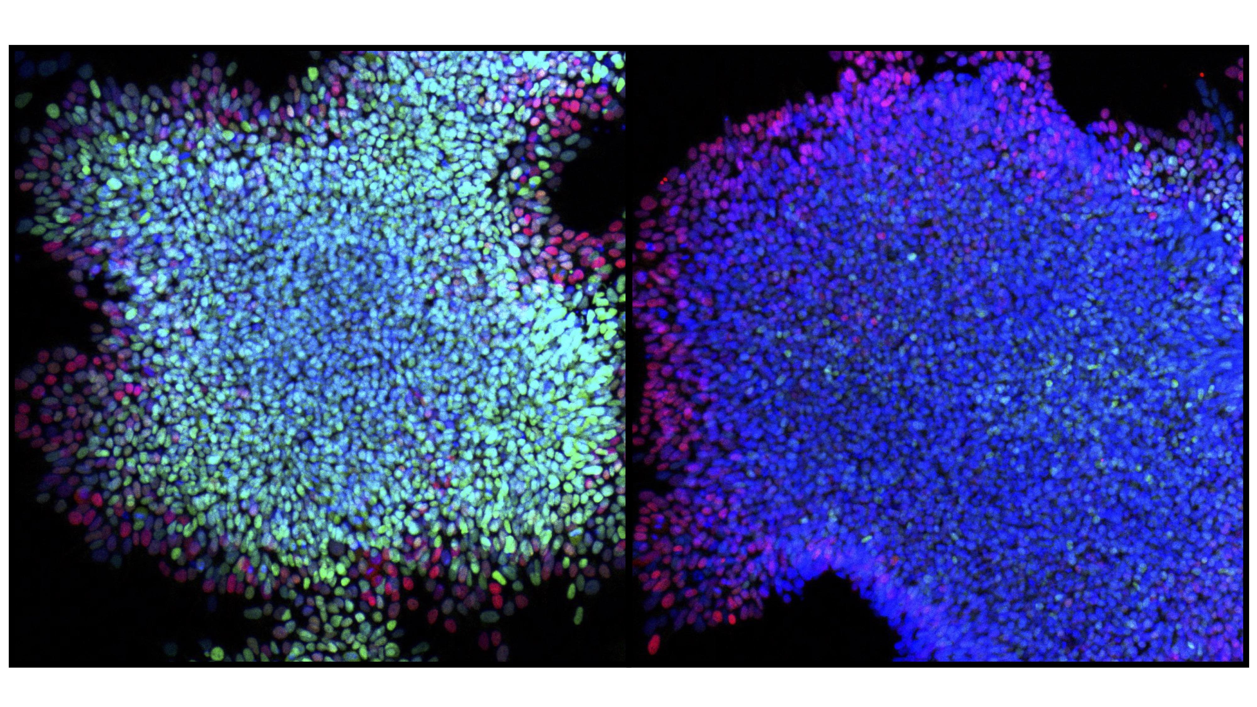 Human embryonic stem cells differentiated into the neuroectoderm germ layer. Normal cells on the right have differentiated, whereas many cells on the left with impaired SMAD2/3 mechanism have not. Image credit: Nature. DOI:10.1038/nature25784 Missing link found between pathways involved in cell development