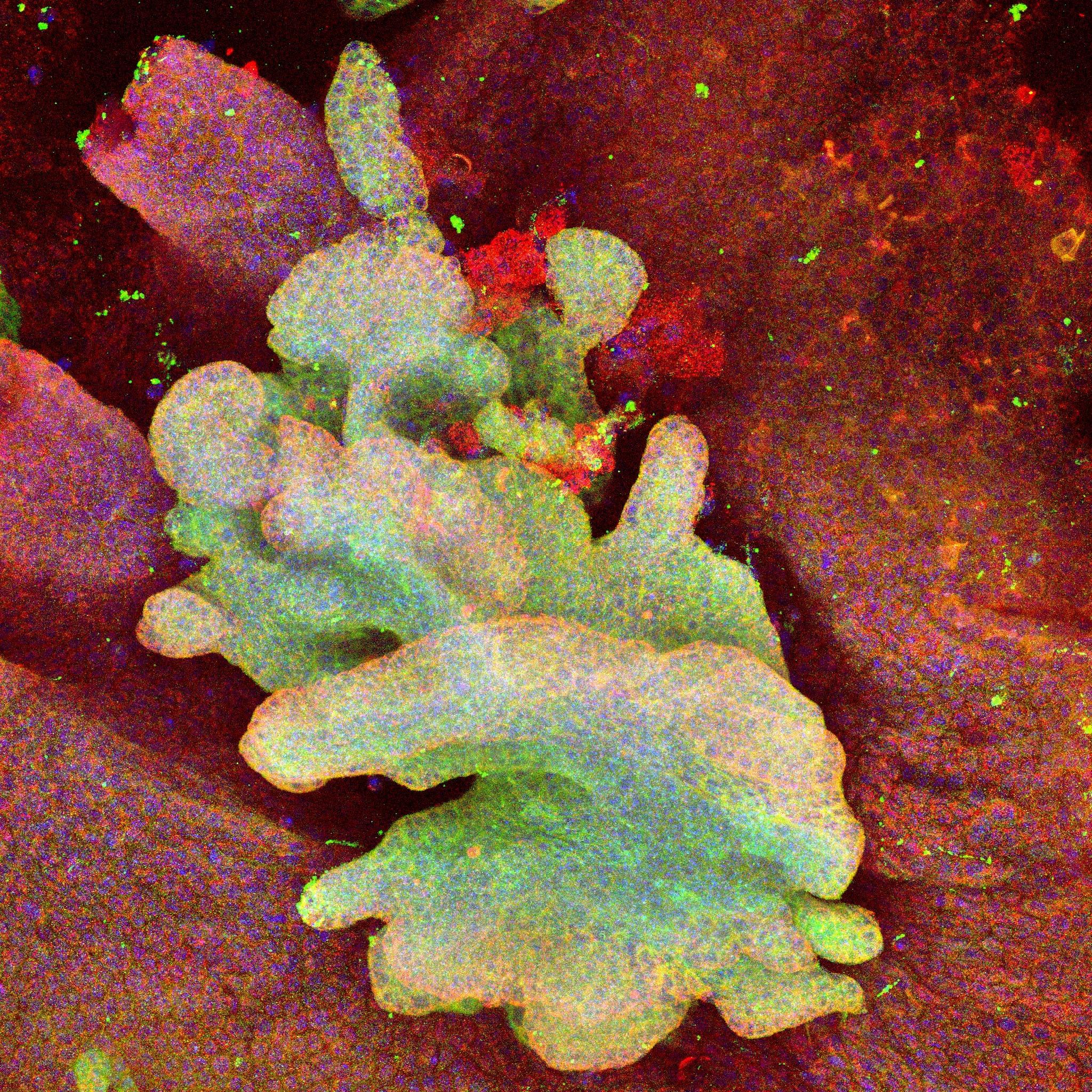 Scientists identify ‘cell of origin’ in skin cancers