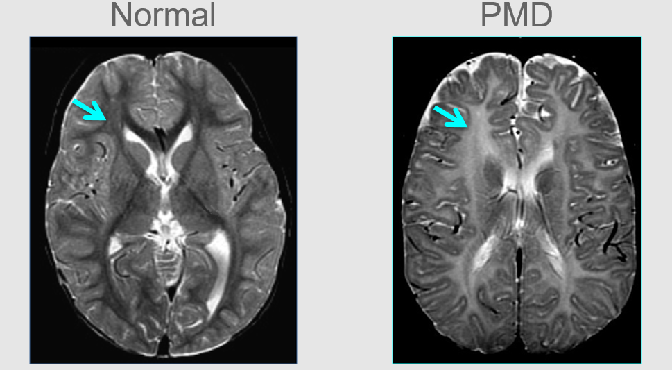Dark patches of myelin in the normal brain (left) compared to lighter areas of reduced myelin in PMD (right). Stem cell studies offer hope for childhood neurological condition