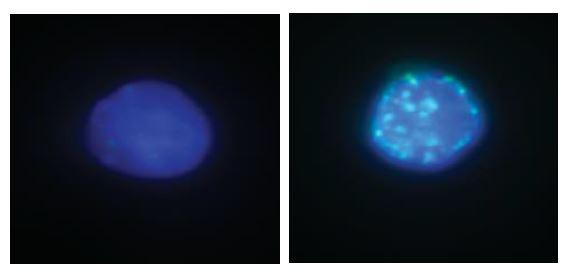 A comparison of lymphocyte precursor cells from healthy mice (left) and from mice lacking CREBBP (right), where damaged DNA can be seen. Stem cells and genetics: the ‘perfect storm’ for cancer progression