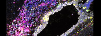 Immune cell exhaustion observed in breast tissue from carriers of BRCA1 and BRCA2 mutations long before breast cancer develops. Credit: Sara Pensa