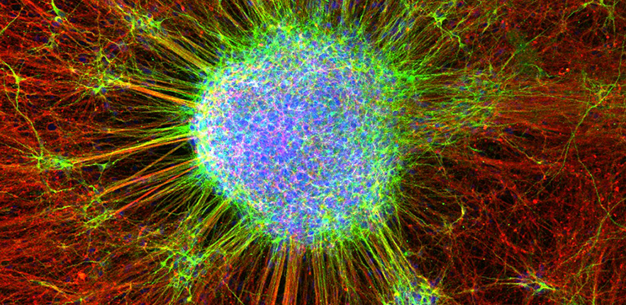 Pluripotent stem cells allow capturing the genetic background in which a disease such as Parkinson's disease (PD) occurs. Induced pluripotent stem cells from a PD patient were turned into neuron progenitor cells that over more than 100 days in culture pro