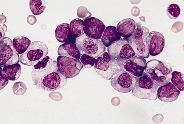 Roots of Leukaemia reveal possibility of predicting people at risk